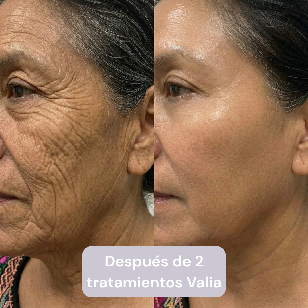 VALIA™ Sistema de Microinfusión Anti Edad