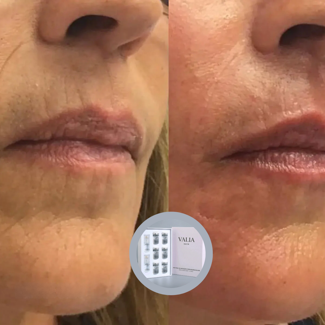 VALIA™ Sistema de Microinfusión Anti Edad